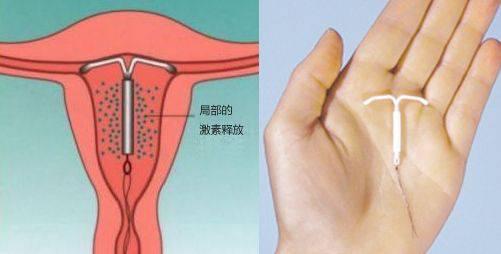 女性带环避孕的副作用有哪些?