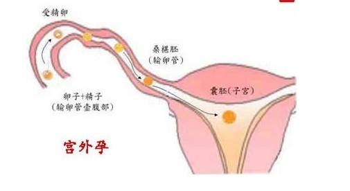 呼和浩特无痛人流手术后多久可以吃辣椒?