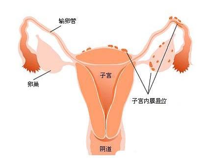 腹壁子宫内膜异位症的典型病例分析