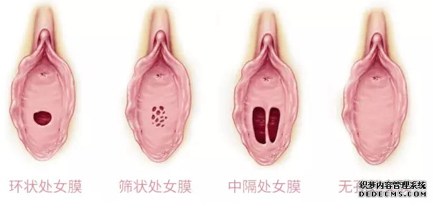 (各种形态的处女膜)
