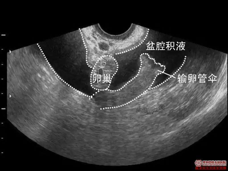 呼和浩特妇科B超和妇科检查傻傻分不清楚?快过来看看吧