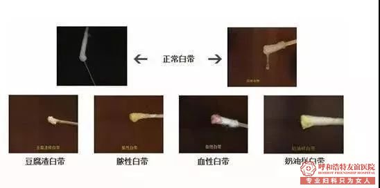 呼和浩特友谊医院女人再穷也不能省这五项妇科检查!