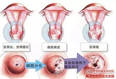 呼和浩特这两种妇科病不严重,引发病变很严重!!!