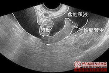 呼和浩特这两种妇科病不严重,引发病变很严重!!!