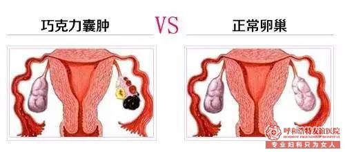 巧克力囊肿 呼和浩特经血颜色重小心巧克力囊肿!