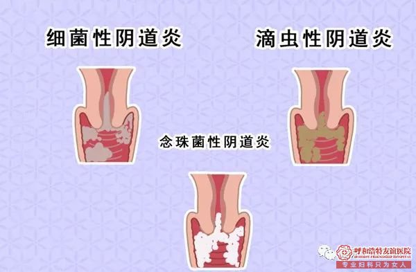 呼市阴道炎“纠缠”着75%的女性,不想受其困扰,注意这些!
